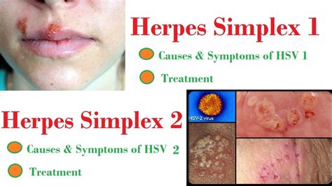 hsv 1 vs hsv 2 symptoms