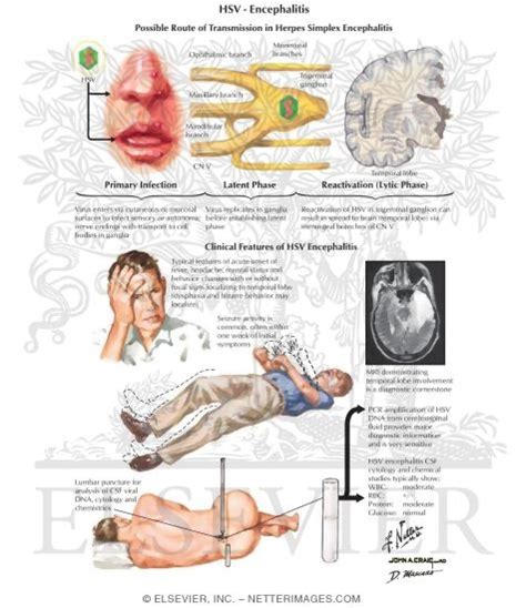 hsv encephalitis contact precautions