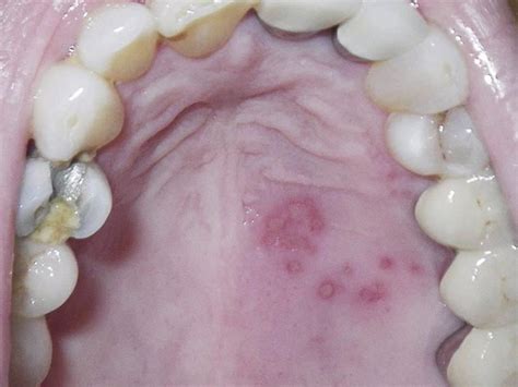 hsv lesion in mouth