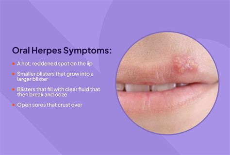 hsv sores in mouth