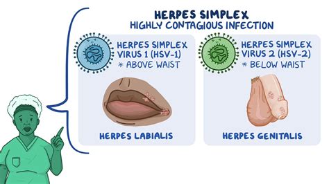 hsv-1 from hsv-2 infections