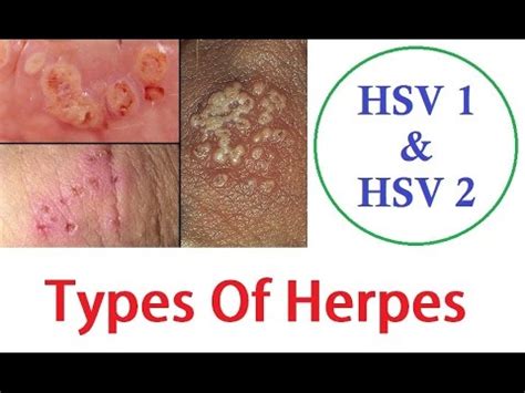 hsv-1 genital herpes