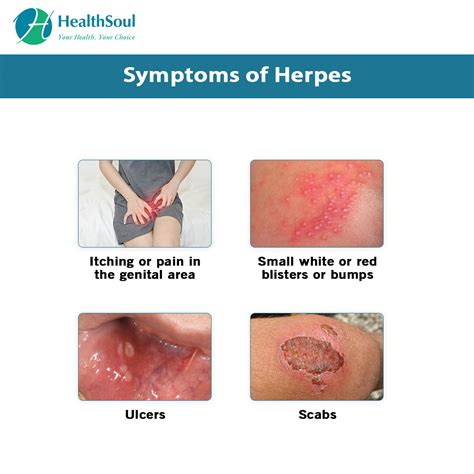 hsv-2 symptoms in females pictures