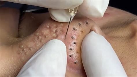 huge blackhead removal