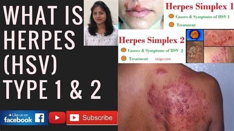 human herpes virus vs herpes simplex virus