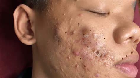 huong acne pimple popping