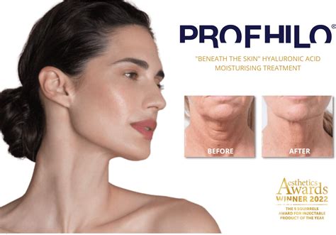 Profhilo Hyaluronic Acid Injections remodel and rehydrate skin