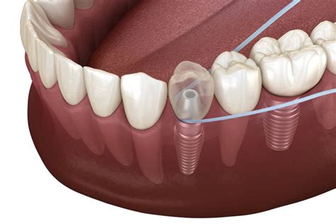 hybridge dental implants cleaning