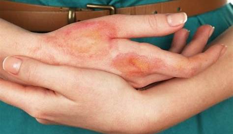 Hydrochloric Acid On Skin What Happens When Conc.HCL Falls Our Hand? Quora