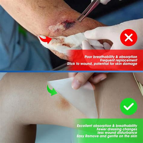 Hydrocolloid Dressing Burns