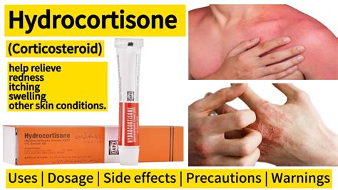 Understanding Hydrocortisone Side Effects: Risks and Precautions Explained