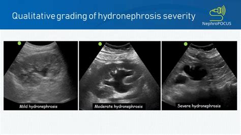 hydronephrosis kidney ultrasound images