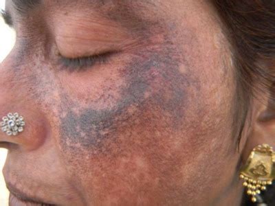 Hydroquinone Bleaching Cream Side Effects