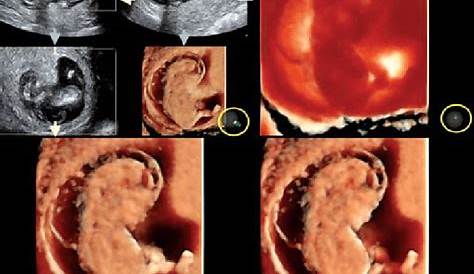 Fetal cystic hygroma colli and hydrops fetalis YouTube