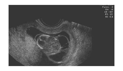 Prenatal diagnosis of a huge cystic hygroma colli