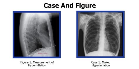 hyperinflated lungs x ray causes