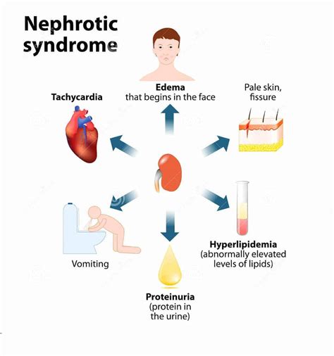 hyperlipidaemia in nephrotic syndrome