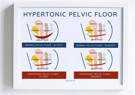 hypertonus of the pelvic floor