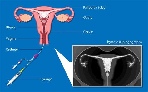 Hysterosalpingogram Infertility