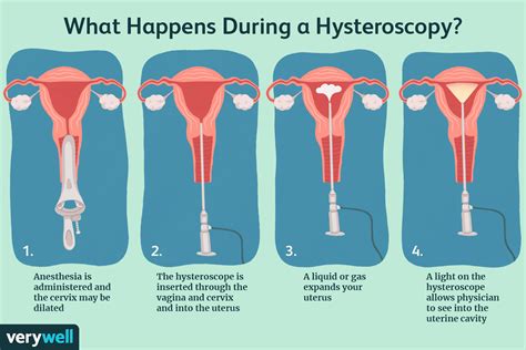 Hysteroscopy
