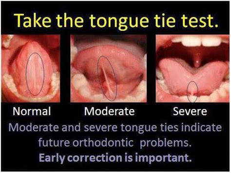 i am tongue tied meaning