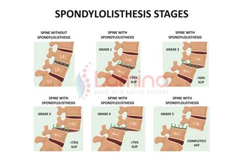 icd 10 acquired spondylolisthesis