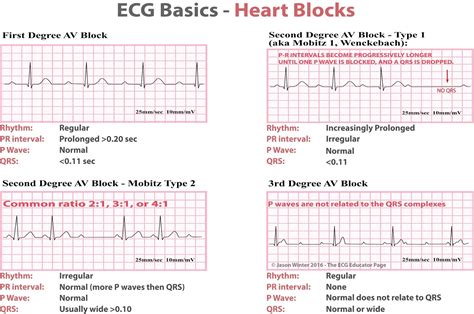 icd 10 cm code for complete heart block