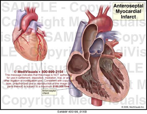 icd 10 code anteroseptal infarct