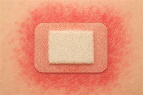 Icd 10 Code For Adhesive Tape Allergy