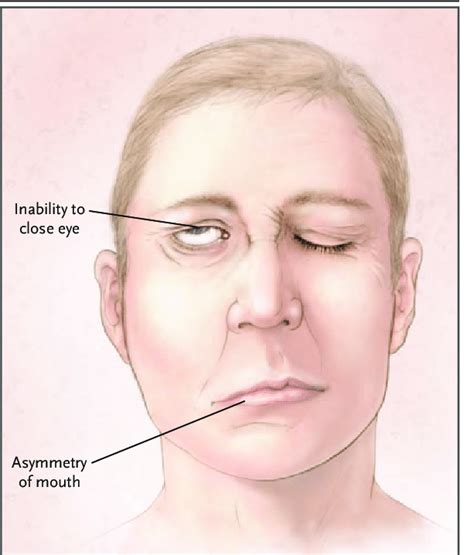 icd 10 code for bell's palsy right eye
