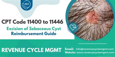 icd 10 code for excision of sebaceous cyst