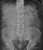 icd 10 code for horseshoe kidney