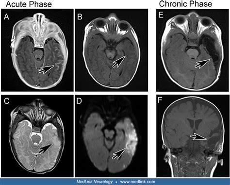 icd 10 code for hsv encephalitis