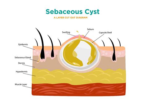 icd 10 code for infected sebaceous cyst neck