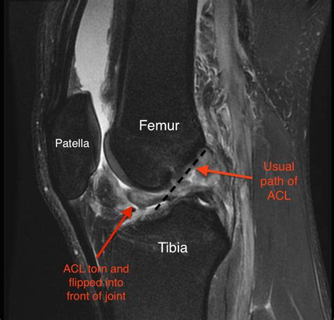 icd 10 code for left acl tear