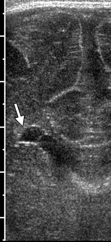 icd 10 code for left adnexal cystic mass