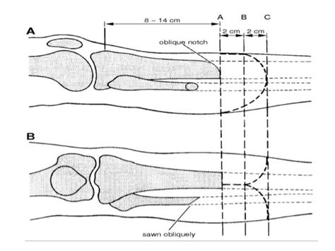 icd 10 code for left aka amputation