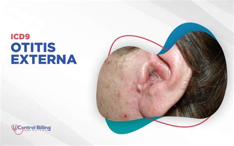 icd 10 code for otitis externa