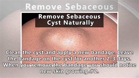 icd 10 code for sebaceous cyst left axilla