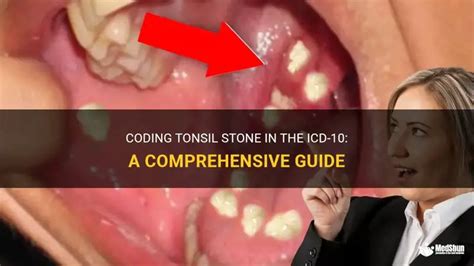 icd 10 code for tonsil stones