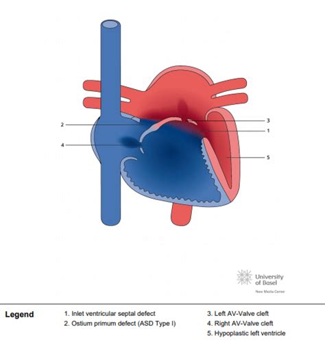 icd 10 code for unbalanced avsd