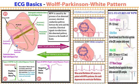 icd 10 code for wolff-parkinson-white