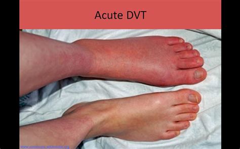 icd 10 dvt lower extremity