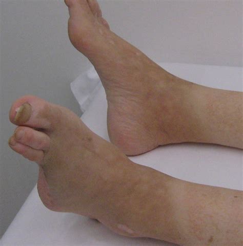 icd 10 for left foot gangrene