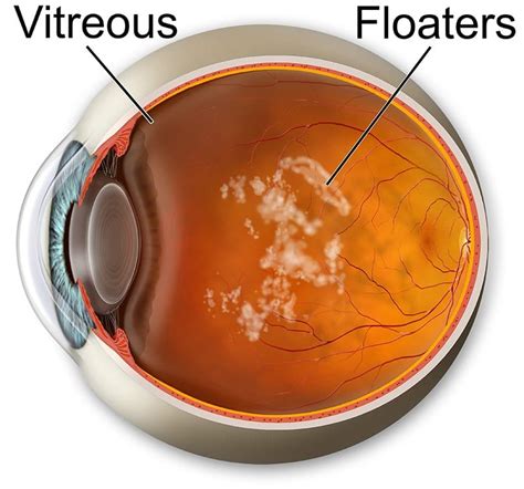 icd 10 for vitreous floaters right eye