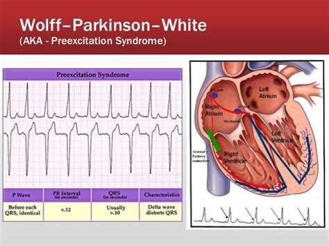 icd 10 for wolff parkinson white