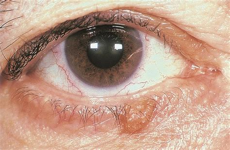 icd 10 lid lesion right eye