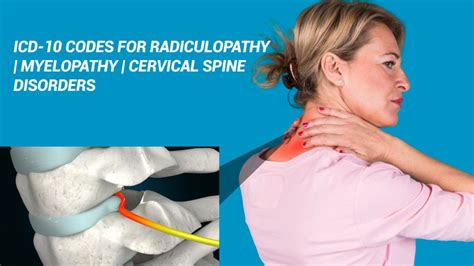 icd 10 neck pain cervical radiculopathy