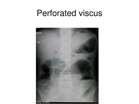 icd 10 perforated viscus