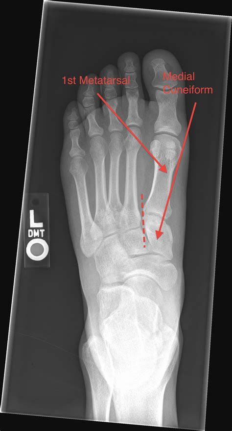 icd 10 right 2nd metatarsal fracture